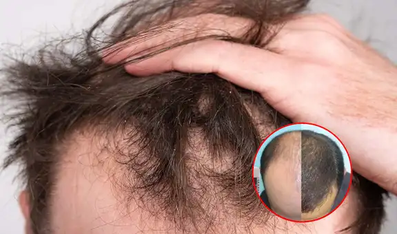 ¿Se te cae el pelo? Esto dice un experto un estudio europeo sobre las causas más comunes y el tratamiento