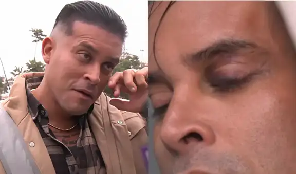 Christian Domínguez sorprende al reaparecer con el ojo morado tras ausentarse de su programa: “Jugué muy fuerte”