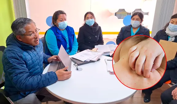 Alerta por varicela en Juliaca: 91 escolares contagiados y 7 instituciones intervenidas, incluida una universidad