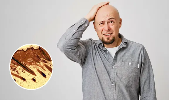 ¿Fin de la calvicie? Científicos de USA descubren la molécula que impulsa el crecimiento del pelo