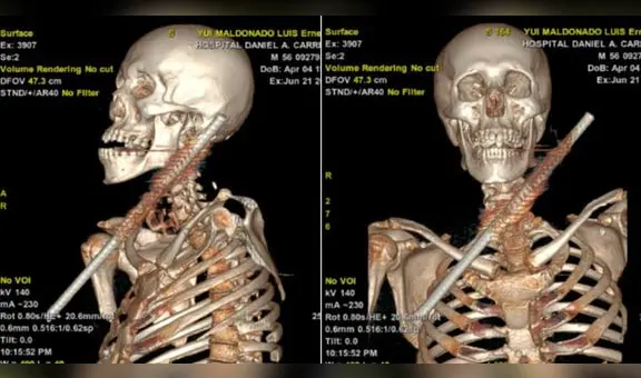 Hospital Carrión: Salvan a paciente que tenía un fierro incrustado en el cuello tras accidente