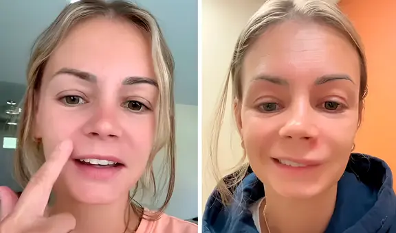 Mujer de EEUU se revienta un grano en el rostro, se infecta de bacterias y por poco pierde la vida