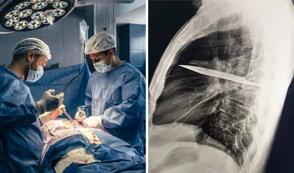 El increíble caso del hombre que vivió 8 años con un cuchillo en el pecho sin saberlo: médicos lo descubrieron tras una infección