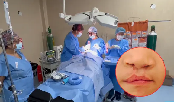 Arequipa: 40 niños serán operados gratis por labio fisurado y paladar hendido en campaña solidaria