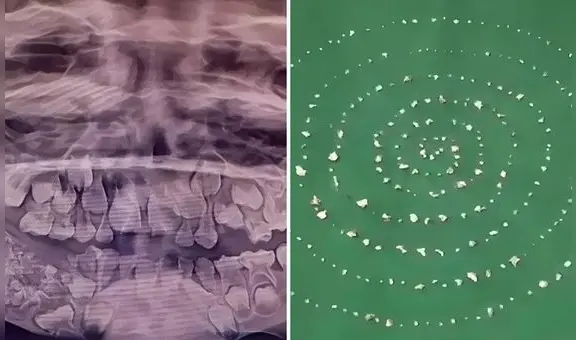 El insólito caso del menor que tenía 526 dientes en la mandíbula y se los extrajeron en una sola cirugía en la India