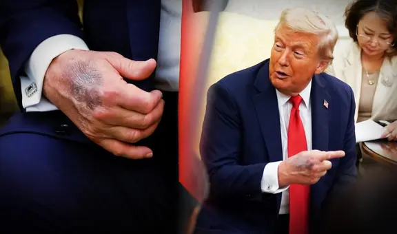 Trump aparece con moretones en las manos y genera preocupación por su estado de salud: ¿qué dicen los médicos?