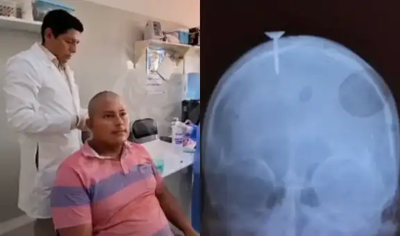 Obrero sobrevive a lesión en la cabeza ocasionada por clavo en Loreto: pistola neumática se activó por accidente