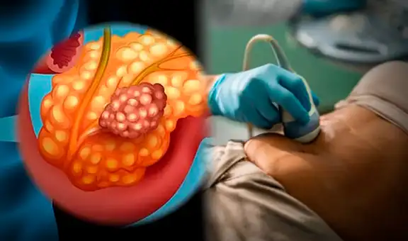 Científicos españoles avanzan en una terapia esperanzadora para eliminar completamente el cáncer de páncreas