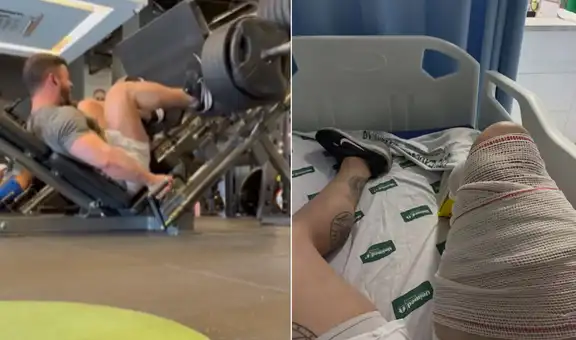 Fisiculturista en Brasil sufre una dura lesión al cargar 400 kg en un ejercicio de piernas: ''El dolor después de la operación fue mucho más intenso''