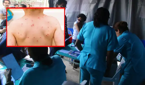 Alerta por sarampión en Perú: experto cuestiona preparación del sistema de salud ante riesgo de reintroducción