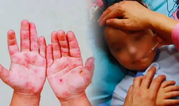 Alerta en el norte del Perú por brote de virus Coxsackie: reportan más de 30 casos de la infección viral "mano, pie y boca"