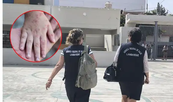 Alerta por virus coxsakie: 38 colegios de Chiclayo reportan el brote de la enfermedad de mano, pie y boca entre sus alumnos