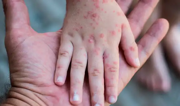 Casos de contagios por virus Coxsackie se duplicaron en colegios a nivel nacional, advierte el Minsa y Minedu