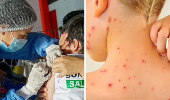 Gobierno declara emergencia sanitaria por brote de sarampión: Lima, Callao y 12 regiones más en alerta