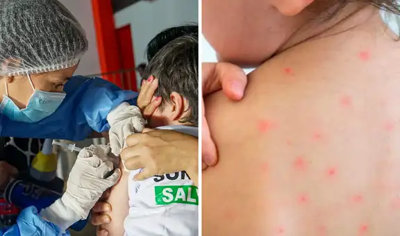 Confirman brote de sarampión en Loreto: Defensoría del Pueblo pide acciones urgentes para frenar transmisión