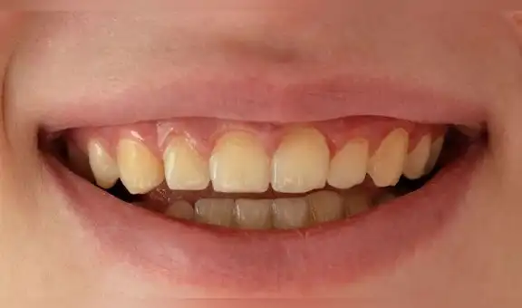 ¿Qué significa soñar que se te caen los dientes? Interpretaciones psicológicas y posibles explicaciones