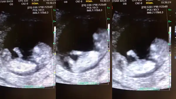 Descubren a bebé de 12 semanas ‘jugando’ en el vientre de su madre [VIDEO]