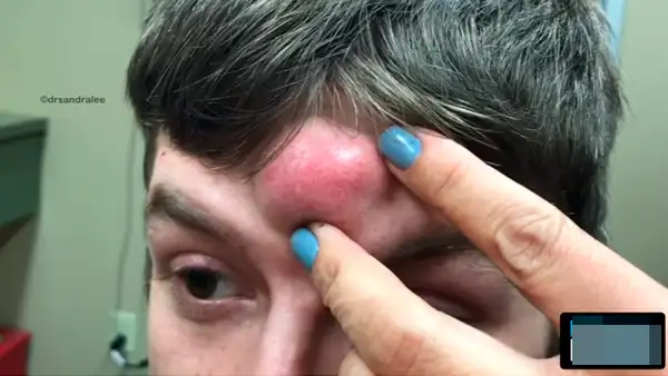 En YouTube, repugnante video de doctora que retiró espinilla gigante