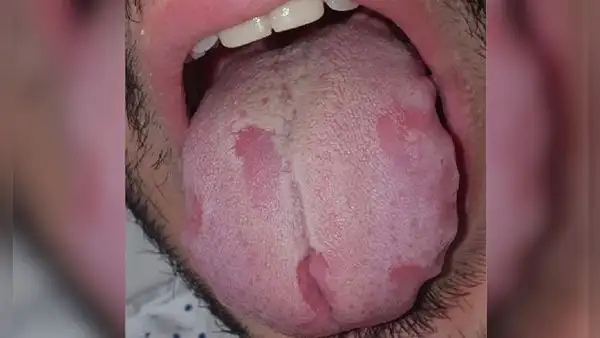 COVID-19: pacientes presentan lesiones en lengua y manchas en la piel