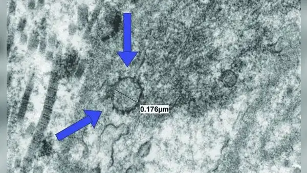 Hallan coronavirus en tejido del pene y lo vinculan a disfunción eréctil grave