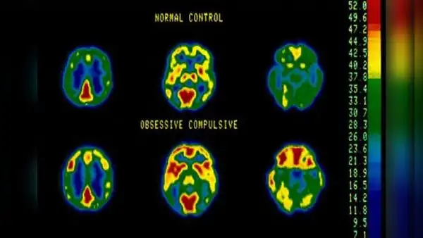 Detectan en tiempo real señales cerebrales asociadas al TOC