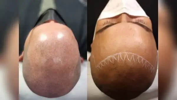 Micropigmentación capilar, una alternativa para la alopecia