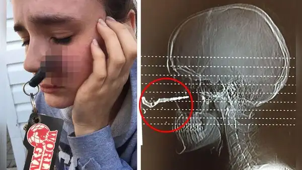 Joven se alistaba para conducir y termina con la llave del auto incrustada en su rostro