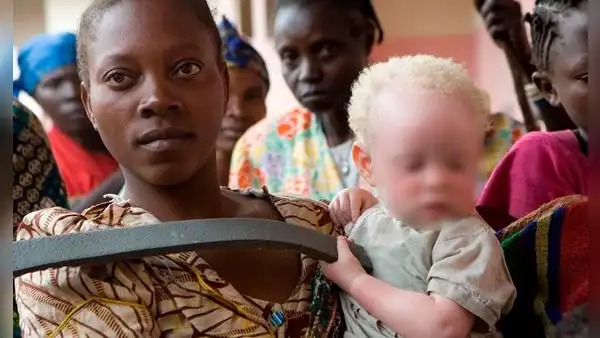 Niño albino fue hallado muerto y desmembrado en presunto ritual mágico en el Congo