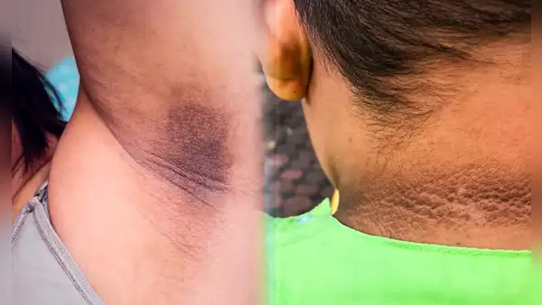 ¿Por qué me salen manchas oscuras en el cuello, axilas o entrepierna, y cómo eliminarlas?