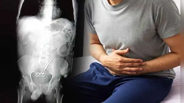 Hombre acude al hospital por dolor abdominal y encuentran tijeras quirúrgicas en su intestino