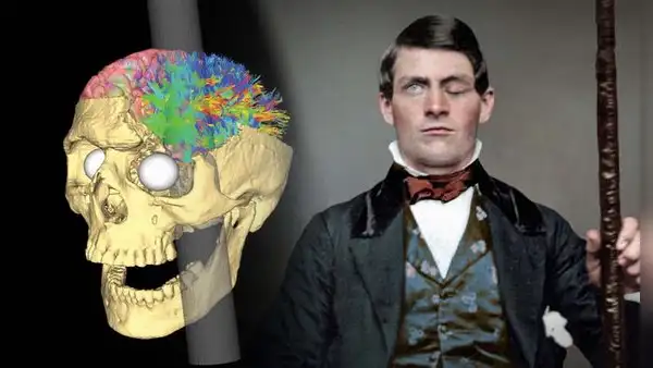 Phineas Gage: el hombre que vivió 12 años con un hueco en el cráneo por una varilla de metal