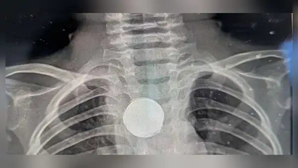 Niño de un año se traga una pila y sobrevive 5 semanas con el objeto atascado en su esófago