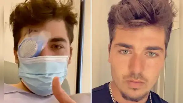 Joven durmió con los lentes de contacto puestos y un parásito se comió su ojo: Fue un dolor inexplicable