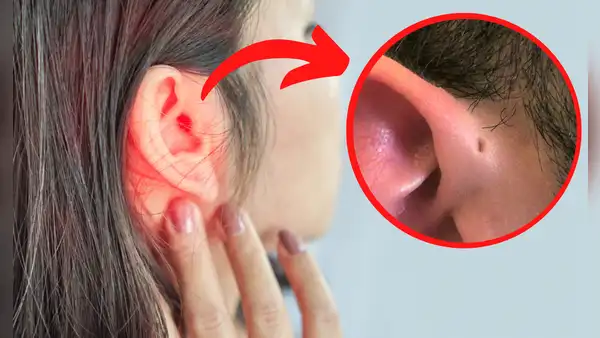 ¿Por qué algunas personas tienen un orificio en la oreja y otras no?