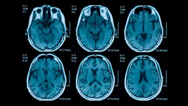 Impactante: estudio revela cuántos años envejece el cerebro tras una noche sin dormir