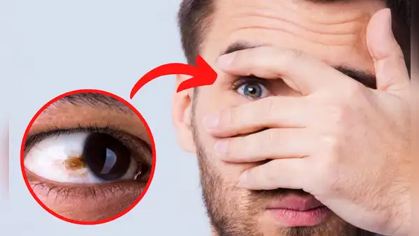 ¿Por qué aparecen lunares en los ojos, qué significan y cuándo deben ser eliminados?