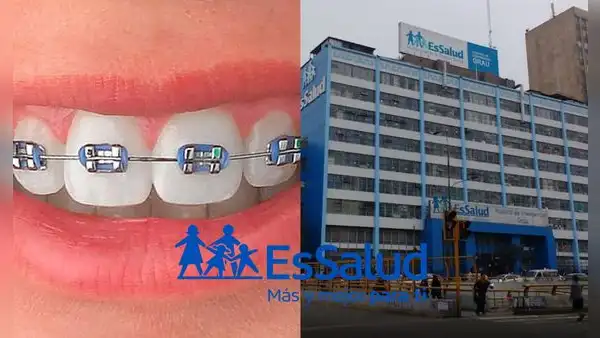 ¿Puedo ponerme brackets con el seguro de EsSalud?