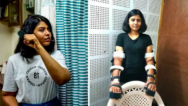 El increíble caso de la mujer que recibió un trasplante de brazos de un hombre y su cuerpo logró adaptarlos