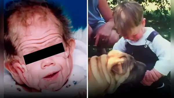 El increíble caso de Tomm Tennent, el bebé que nació con un alarmante exceso de piel
