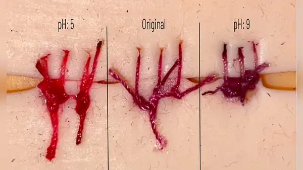Inventan hilos de sutura que cambian de color al detectar heridas infectadas