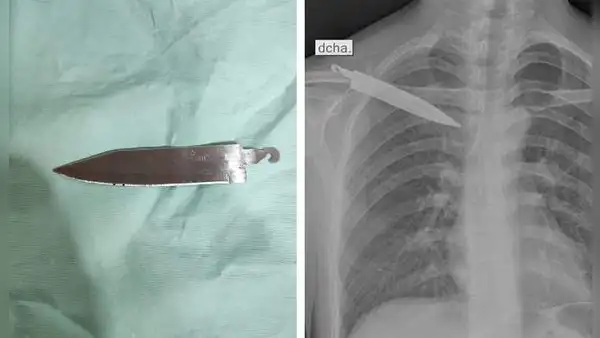 Médicos suturaron lesión a joven, pero le dejaron un cuchillo en la espalda por más de un mes