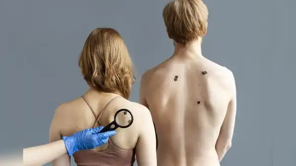 Riesgo de cáncer de piel se incrementa debido a las altas temperaturas en el norte