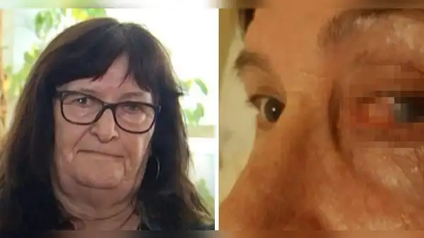 Domi, la mujer que pasó más de 50 años con una piedra en el ojo y nadie le creyó
