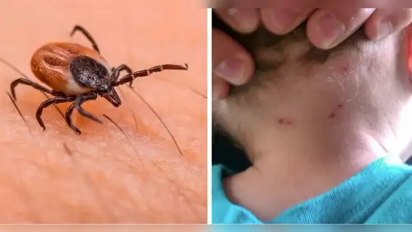 Niño de 4 años muere tras contraer enfermedad letal por picadura de garrapata en México