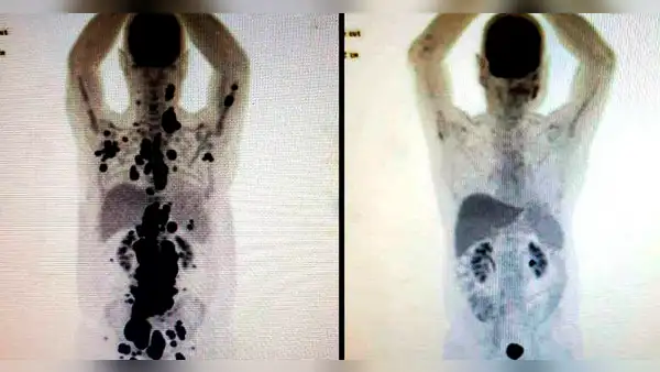 El antes y después de un paciente con cáncer que recibió prometedora terapia de células