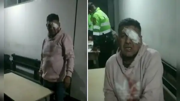 Ate: hombre pierde visión de un ojo por presunto abuso de autoridad policial, pero PNP lo niega