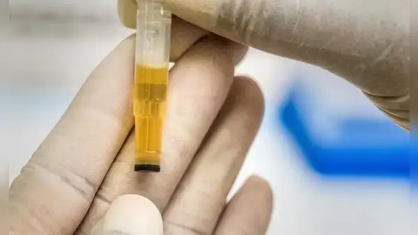 ¿Qué significa el color de la orina y en qué casos representa una infección?