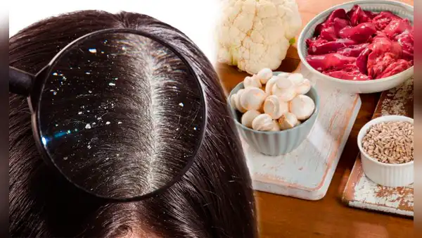 ¿Qué vitamina ayuda a prevenir la caspa y combate la pérdida de cabello?