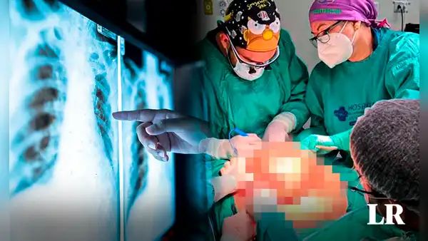 Equipo de más de 20 médicos extirpa un tumor de 4,2 kilos en operación de 11 horas en Chile