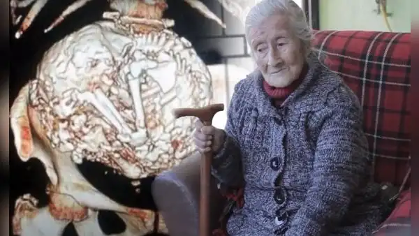 Estela Meléndez, la anciana que tuvo por más de 60 años un feto momificado dentro de su cuerpo